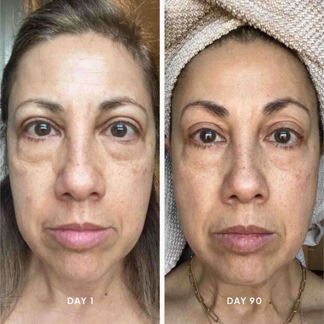 before & after skincare photos