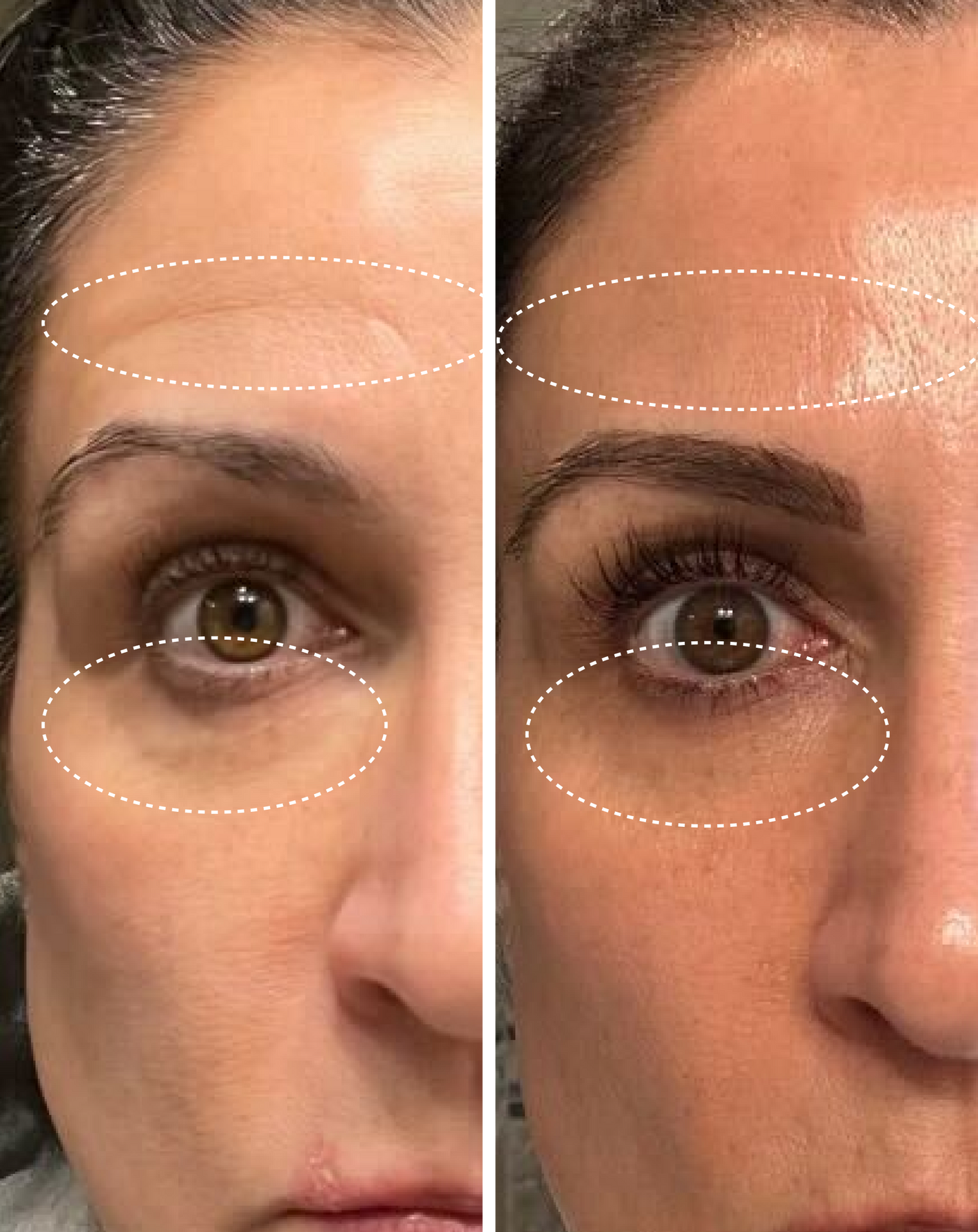 Two side by side images of a female-presenting person showing skin before and after 2 weeks use of Droplette Collagen Hydrofiller