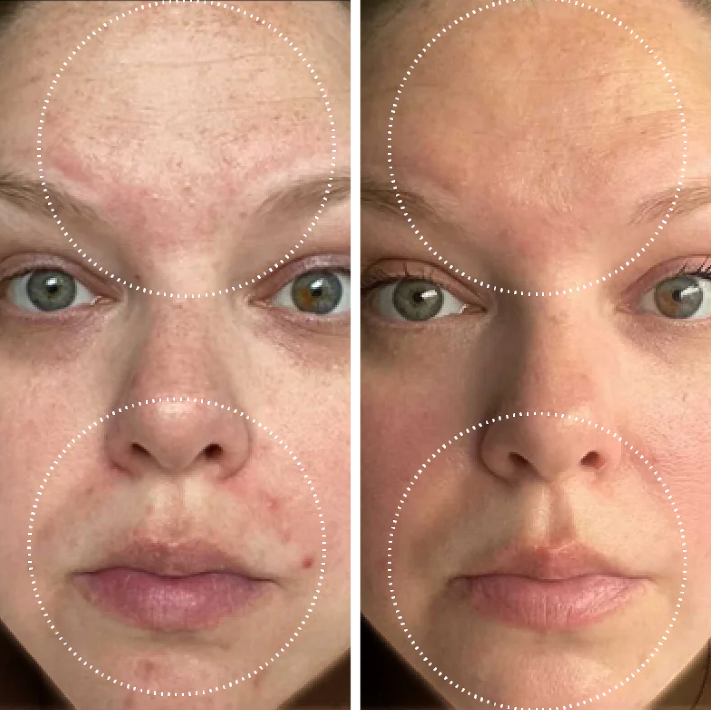 Two side by side images of a female-presenting person showing skin before and after 2 weeks use of Droplette Glycolic Illuminator + Retinol Renewer
