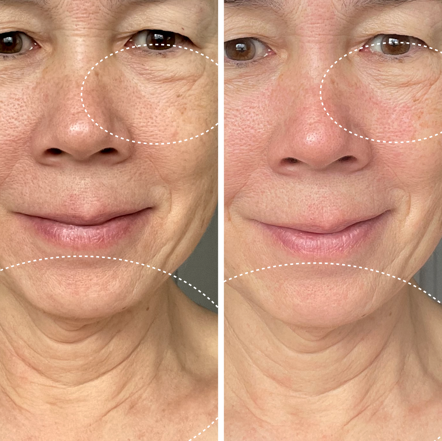Two side by side images of a female-presenting person showing skin before and after 2 weeks use of Droplette Radiant Detox