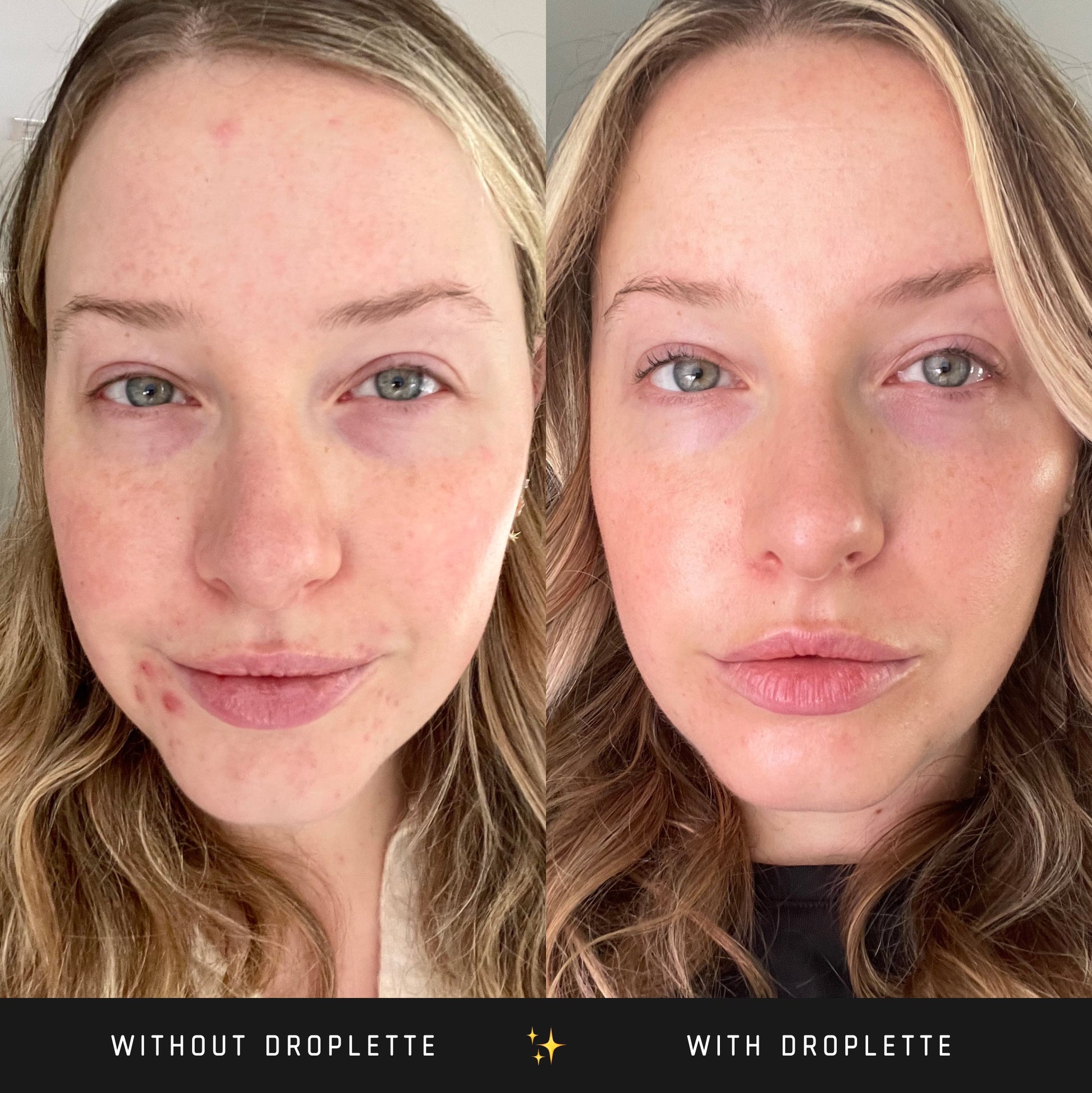 Droplette regimen before and after photos with improved skin appearance